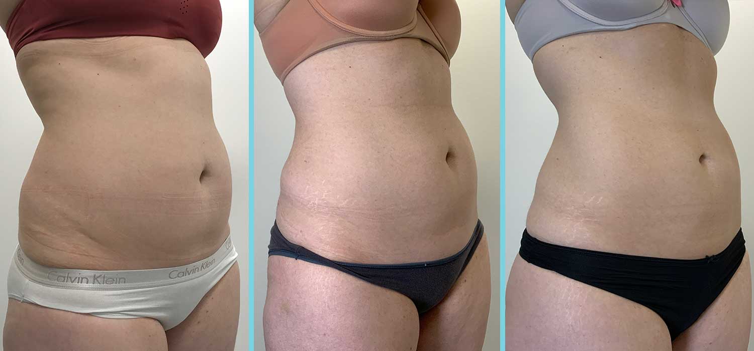 next-fatfreeze-positieve-beoordelingen2 Next Fatfreeze positieve beoordelingen door goed resultaat