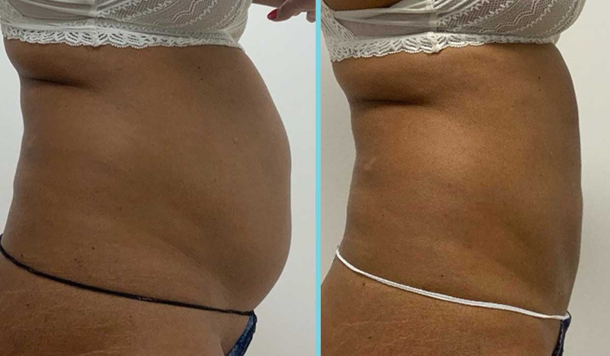 next-fatfreeze-behandeling-tegen-cellulite Zo werkt een behandeling huidverstrakking
