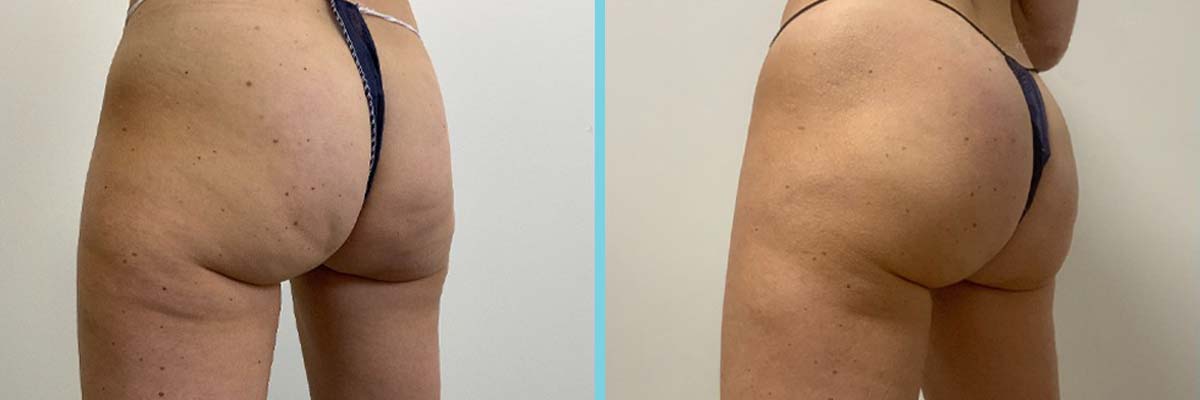 Resultaat na een behandeling met de Emsculpt