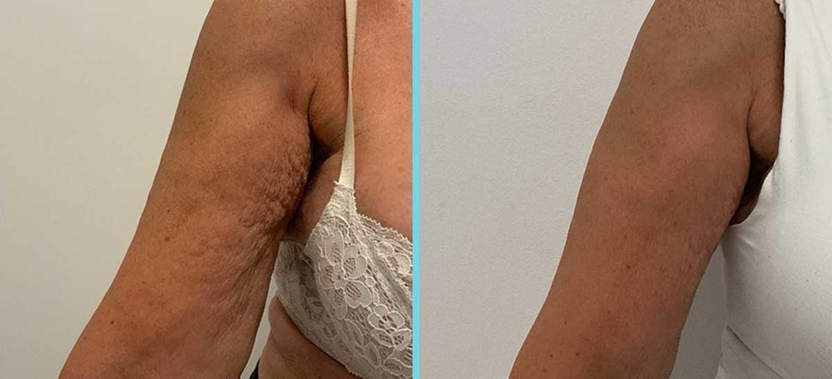 T shape 2 behandeling huidverstrakking armen