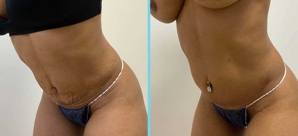 T shape 2 behandeling huidverstrakking buik