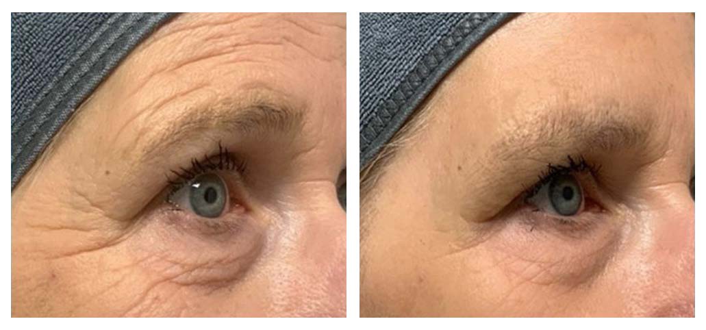 T-Shape 2 gezichtsbehandeling voor huidverstrakking – voor en na resultaat